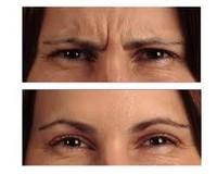 Photo avant et après: injection de Botox, triatement contre les rides du visage