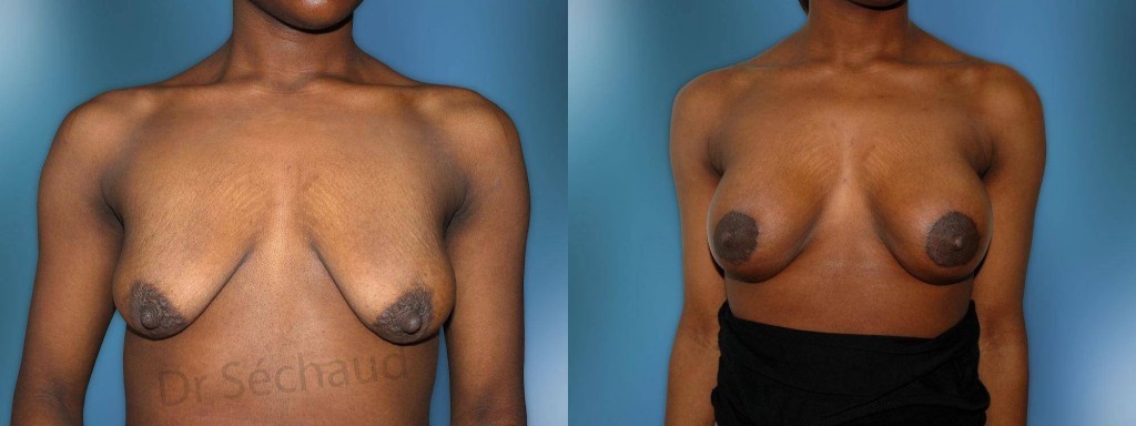 operation-poitrine-tombante-chirurgie-seins-flasques