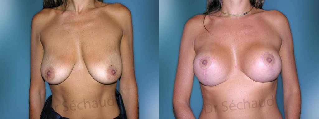 photo-avant-apres-chirurgie-ptose-mammaire
