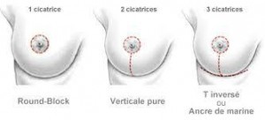 cicatrice round block et verticale suite à plastie mammaire