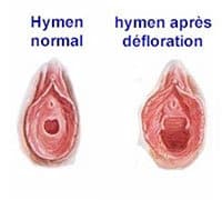 Photo hymen vierge et après hymenoplastie