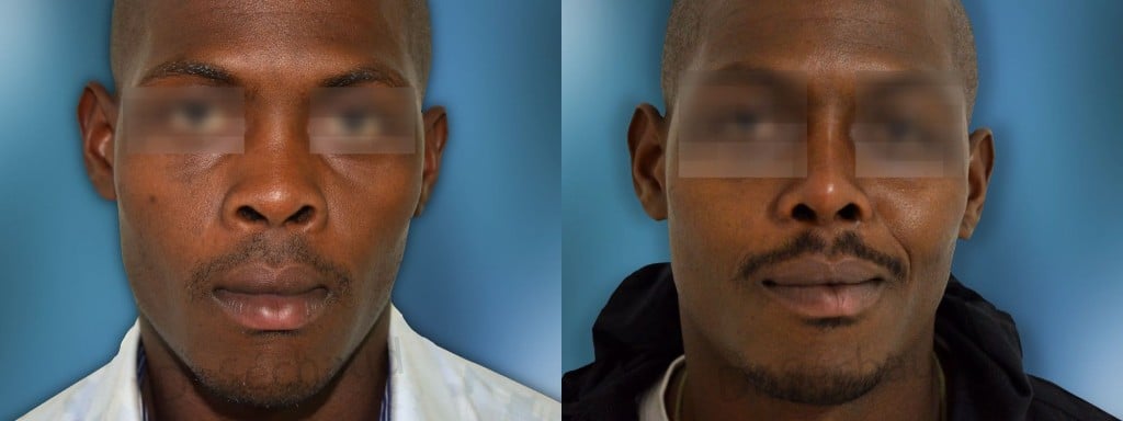 photo rhinoplastie homme africain: chirurgie esthétique nez large