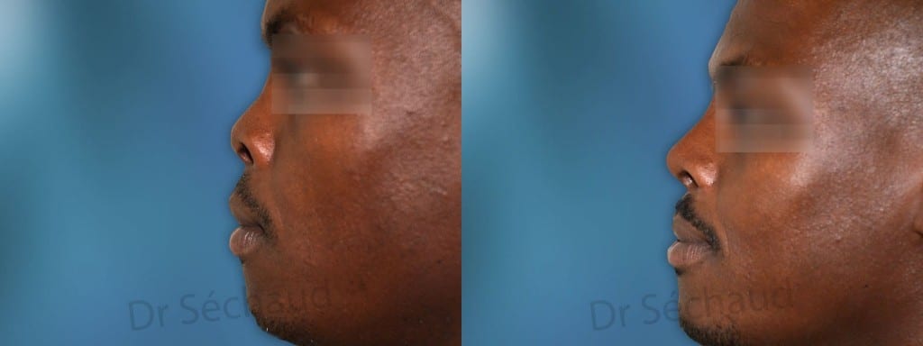 photo avant après d'une opération de nez africain, homme noir