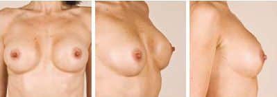 photos avant apres de macrolane, gel acide hyaluronique, augmentation mammaire sans chirurgie