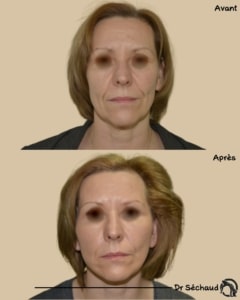 Lifting cervico-facial avant apres : rajeunissement du visage