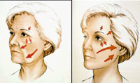 Rajeunissement du visage et muscles (SMAS)