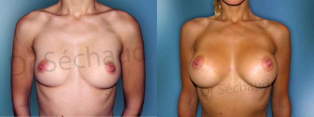 Augmentation mammaire: photo avant après 