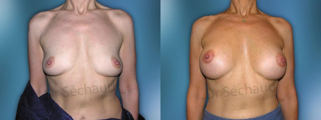 Photos augmentation chirurgie plastique des seins