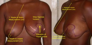 photos avant après reduction mammaire et lifting du seins