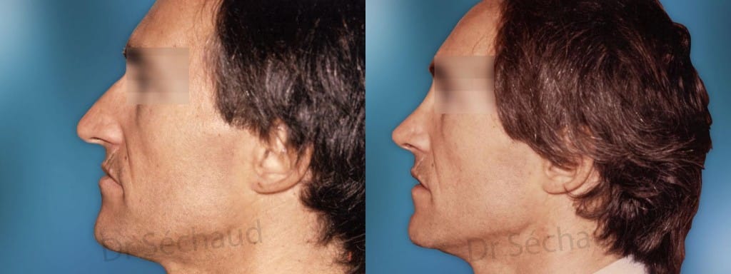 Photo chirurgie du nez avant après
