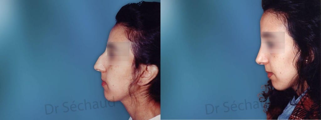 photo rhinoplastie du nez avant après