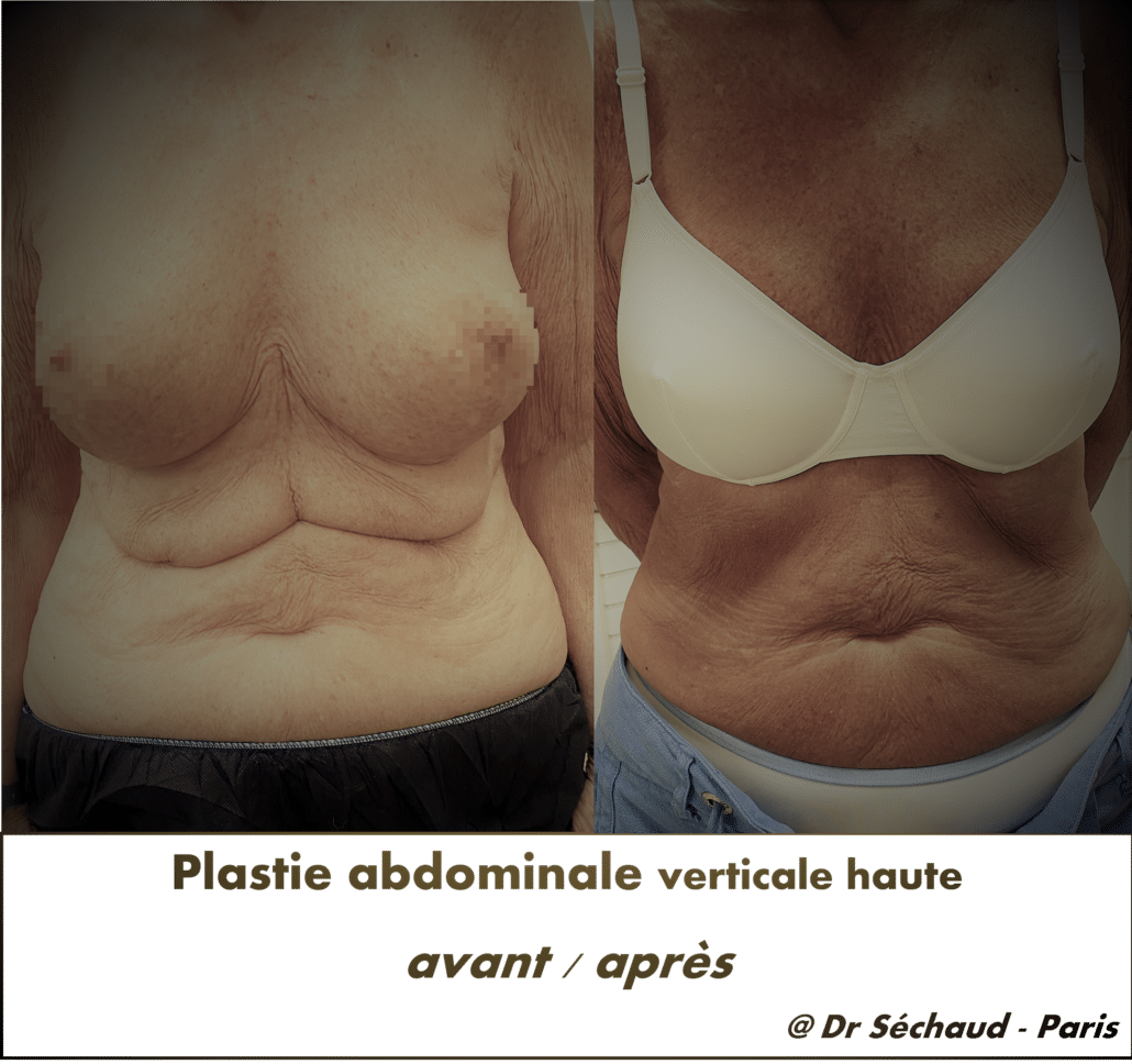 plastie abdominale : retrouver un ventre plat du ventre
