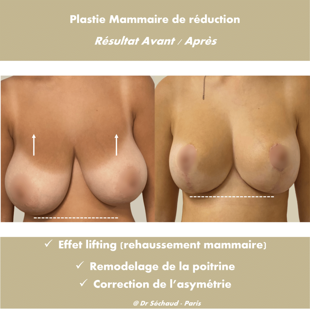 Plastie et réduction mammaire et correction de l'asymétrie