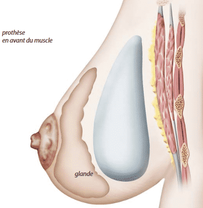 Implant mammaire devant le muscle et devant la glande